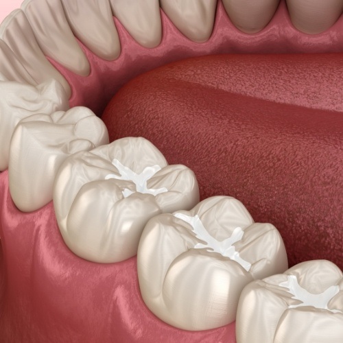 Animated smile with tooth colored fillings after restorative dentistry