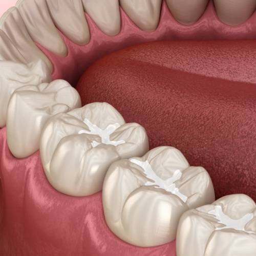 Animated teeth with fillings