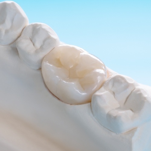 Model smile with dental crown restoration