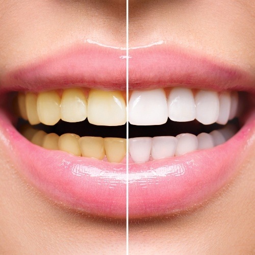 Smile before and after teeth whitening