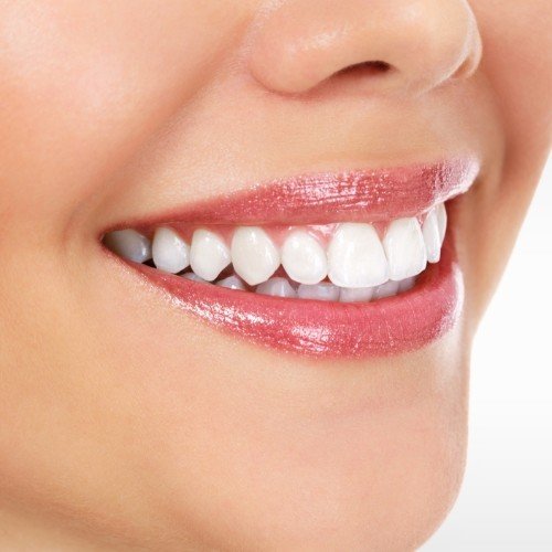 Flawless smile after gum recontouring