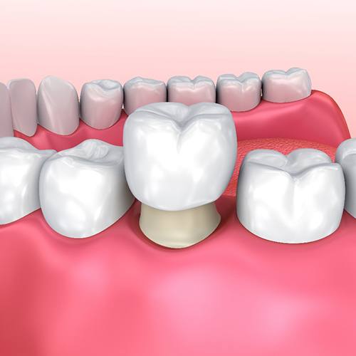 Illustration of dental crown in Holliston, MA on a tooth