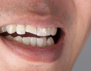 Smile with chipped front tooth