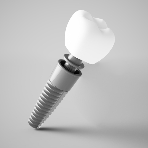 Animated dental implant supported dental crown