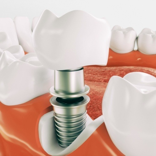 Animated smile during dental implant supported tooth replacement process