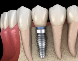 Animated smile with dental implant supported dental crown