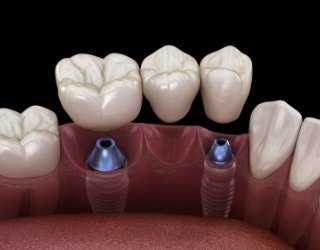 Animated smile with dental implant supported fixed bridge