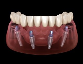 Animated smile with dental implant supported denture