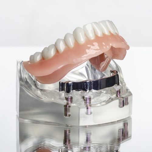 Model dental implant supported denture