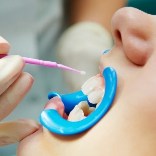 Patient receiving fluoride treatment