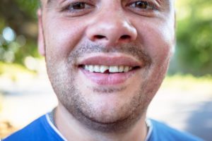 a man showing his chipped tooth